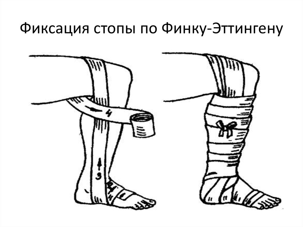 Фиксация это. Бинтование по методу финка-Эттингена. Бинтование стопы по финку Эттингену. Бинтование при косолапости. Корригирование косолапости по финку_Эттингену.