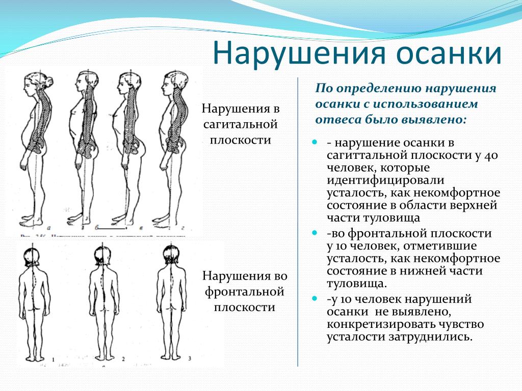 Рассмотрите рисунки 1 3 с изображением изменений осанки человека как называется нарушение осанки 3