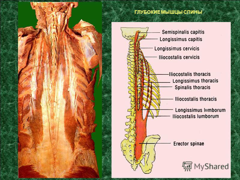 Глубокая поясница. Глубокие мышцы спины анатомия препарат. Глубокие мышцы спины иннервация. Глубокие Аутохтонные мышцы спины. Глубокие мышцы позвоночника анатомия.