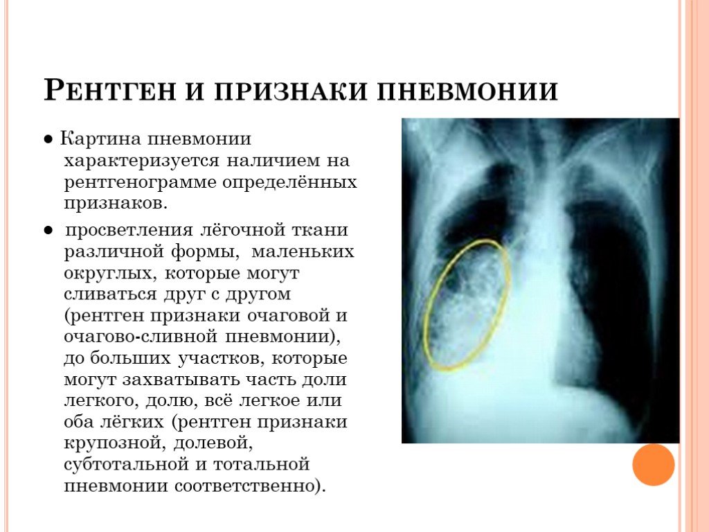 Воспаление легких без температуры признаки у взрослого. Рентген критерии пневмонии. Рентгенография при внебольничной пневмонии. Пневмония симптомы рентген. Рентген легких пневмония протокол.