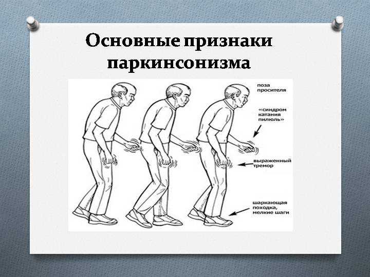 Паркинсон признаки. Основные симптомы болезни Паркинсона. Плзодка ПРИПАРКИНСОНЕ. Болезнь Паркинсона походка. Поза просителя при болезни Паркинсона.