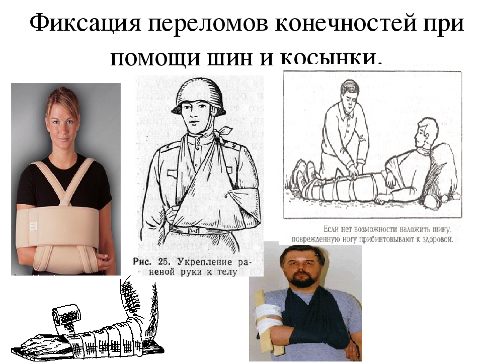 Помощь при переломе ноги. Фиксация конечности при переломе. Фиксирование конечностей при переломе. Фиксирование руки при переломе. Фиксация ноги при переломе.