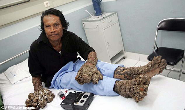The disease was so severe his hands and feet (pictured) were covered in more than 13lbs of warts. Here he is pictured prior to surgery in February, 2009