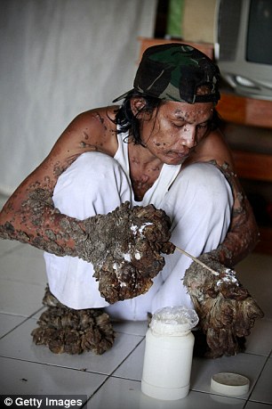 Indonesian man Dede Koswara treats his illness with cream in his home village Bandung, Java