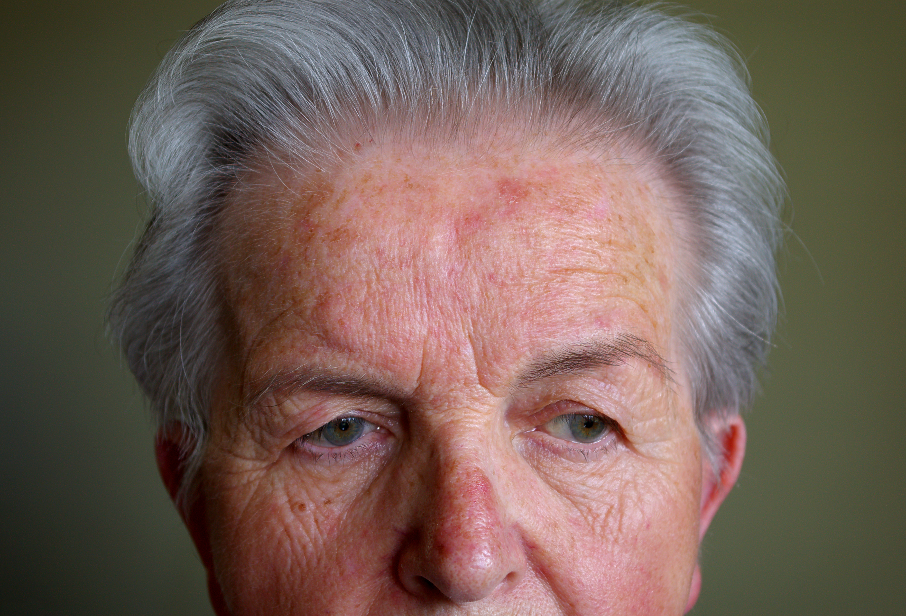 Заболевания в старом возрасте. Розацеа телеангиэктазии. Лица пожилых людей. Старческое мужское лицо.